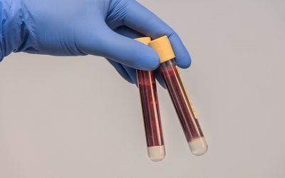 Biopsia líquida: Los oncólogos reclaman mayor financiación para la oncología de precisión