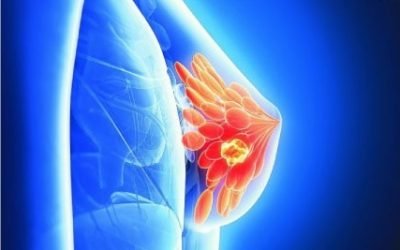 El cáncer de mama metastásico triple negativo a través de Tamara