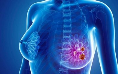 La principal necesidad no cubierta en cáncer de mama metastásico es eliminar la progresión de la enfermedad
