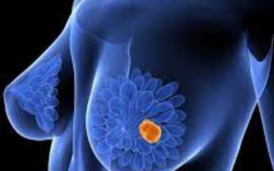 SEOM2023| Comienza una “nueva era” en el abordaje del cáncer de mama metastásico HER2+