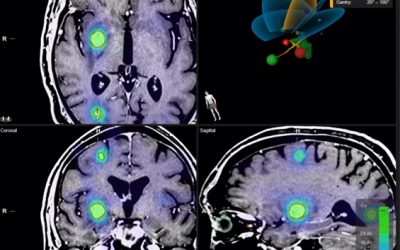 La radiocirugía craneal (SRS) y extracraneal (SBRT) dos aliadas a vuestro lado