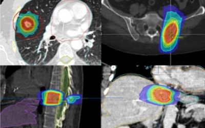La radiocirugía craneal (SRS) y extracraneal (SBRT), parte II. Indicación clínica
