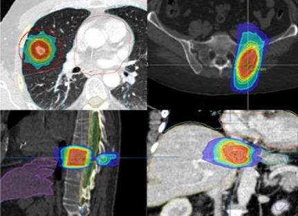 La radiocirugía craneal (SRS) y extracraneal (SBRT), parte II. Indicación clínica