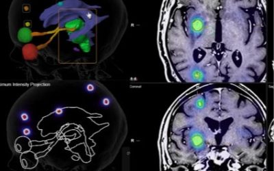 La radiocirugía craneal (SRS) y extracraneal (SBRT), parte III. Alcance
