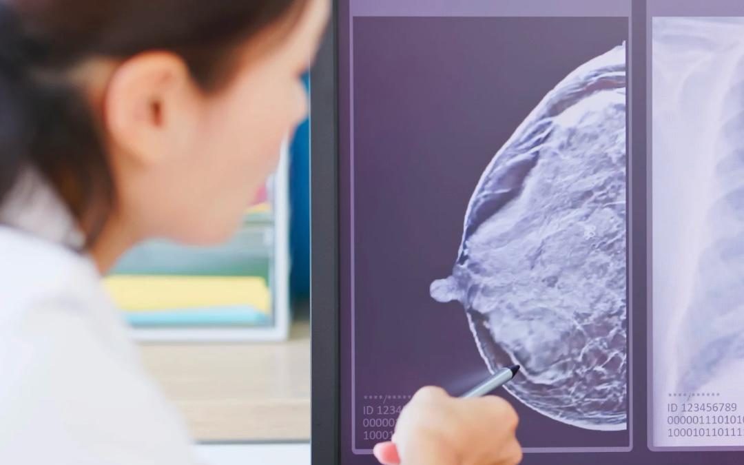 Comprendiendo el Cáncer de Mama HER2-low